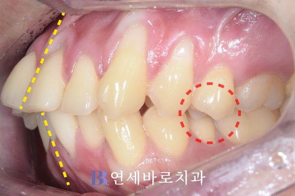 대전 투명교정 환자분, 돌출입 교정 전