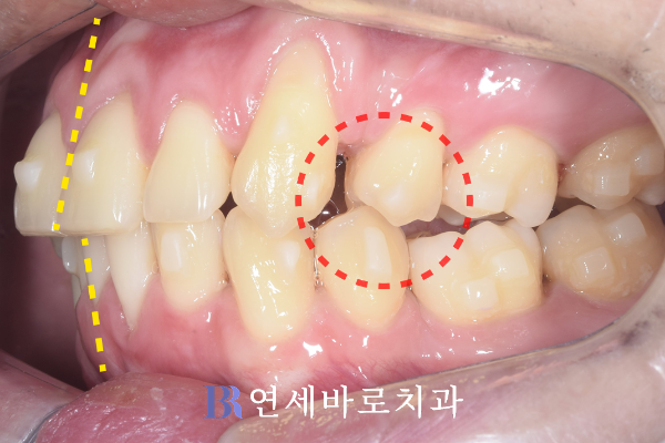 대전 투명교정 진행 중, 치아 각도가 많이 줄어들었음.