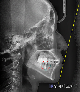 치료 후 ①
