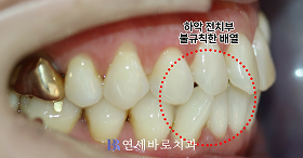 치료 전 ②