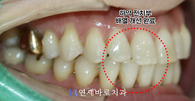 치료 후 ②