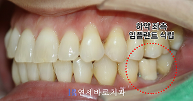 치료 후 ③