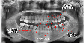 치료 전 ④