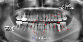 치료 후 ④