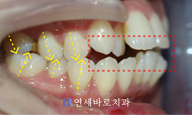 치료 전 ①