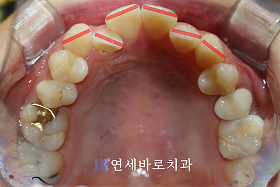 치료 전 ②