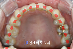 치료 후 ②