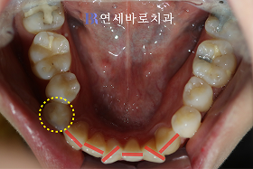 치료 전 ③