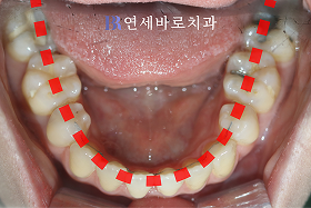 치료 후 ③
