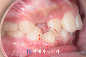 치료 전 ①