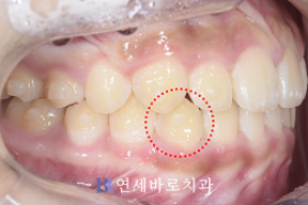 치료 후 ①