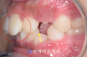 치료 전 ②