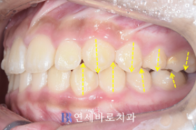 치료 후 ②