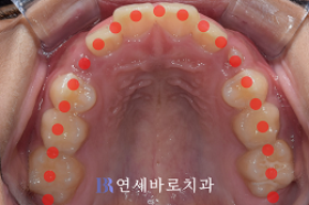 치료 전 ③