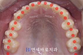 치료 후 ③