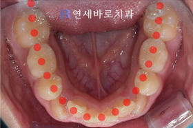 치료 전 ④