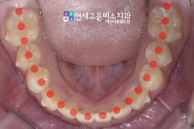 치료 후 ④