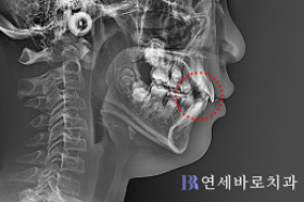 치료 전 ⑤