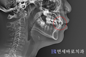 치료 후 ⑤