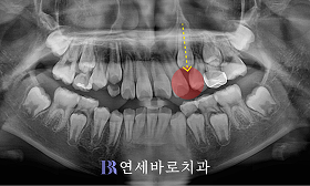 치료 전 ①