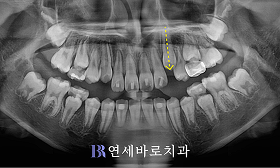 치료 후 ①