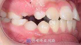 치료 전 ②
