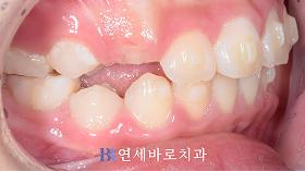 치료 후 ②
