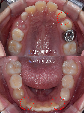 치료 전 ③