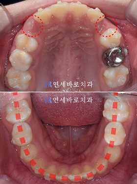 치료 후 ③