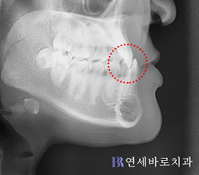 치료 전 ①