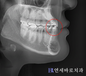 치료 후 ①