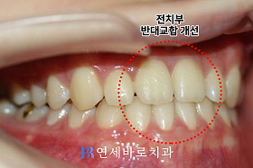 치료 후 ②