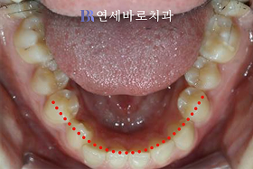 치료 전 ④