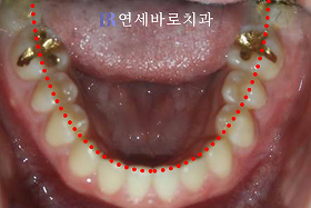 치료 후 ④