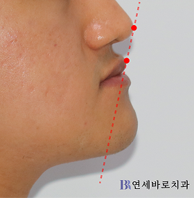 치료 전 ①