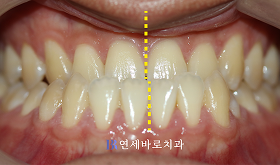 치료 전 ②
