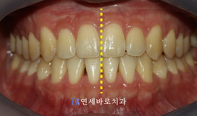 치료 후 ②