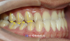 치료 전 ③