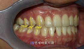 치료 후 ③