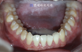 치료 전 ④