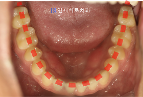 치료 후 ④