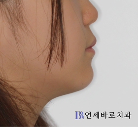 치료 전 ①