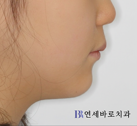 치료 후 ①