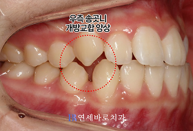 치료 전 ②
