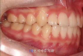 치료 후 ②