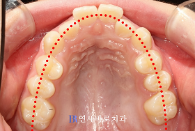치료 전 ③