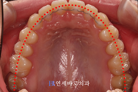치료 후 ③