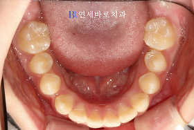 치료 전 ④