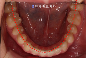 치료 후 ④
