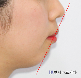 치료 전 ①